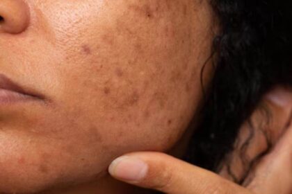 dark spots