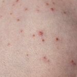 skin infection